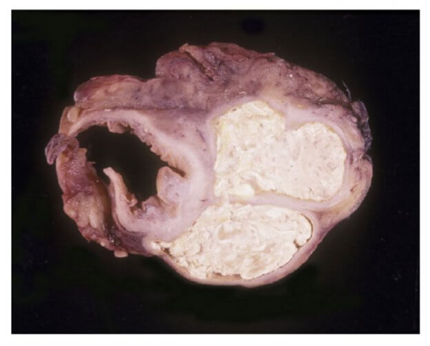 Visceral Gout in Colon