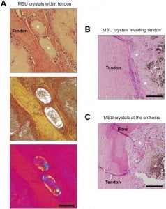 Uric Acid Crystals Attack Tendons